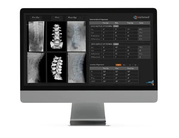Kaiyun：融资1亿美元升级钛金属3D打印脊椎植入物Carlsmed将在纳斯达克上市(图3)