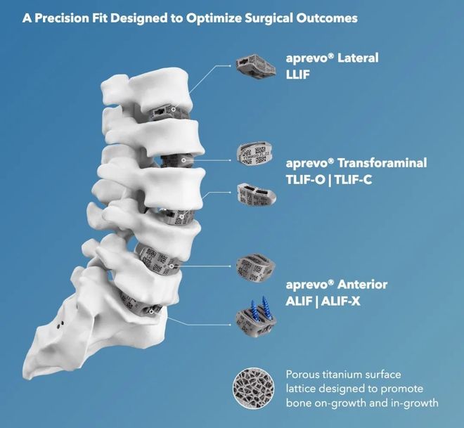 Kaiyun：融资1亿美元升级钛金属3D打印脊椎植入物Carlsmed将在纳斯达克上市(图2)