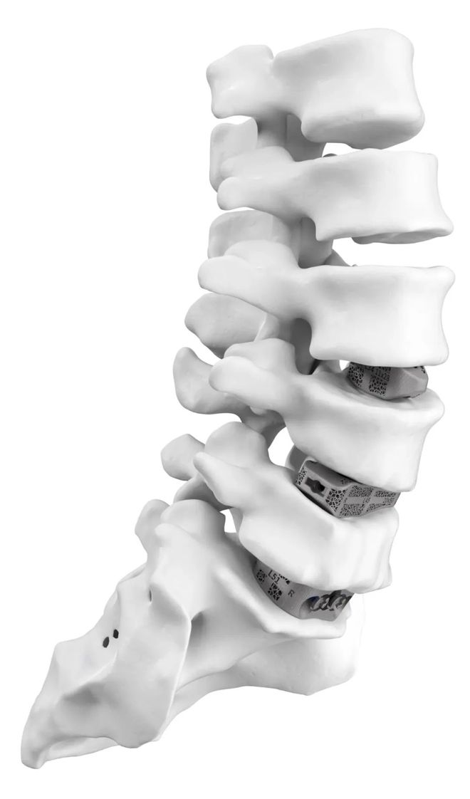 Kaiyun：融资1亿美元升级钛金属3D打印脊椎植入物Carlsmed将在纳斯达克上市(图4)