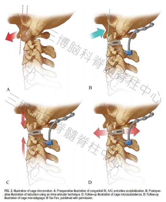 【手术技术分析】3D打印融合器和PEEK融合器用于颅颈交界区畸形关节间手术的效果比较(图3)