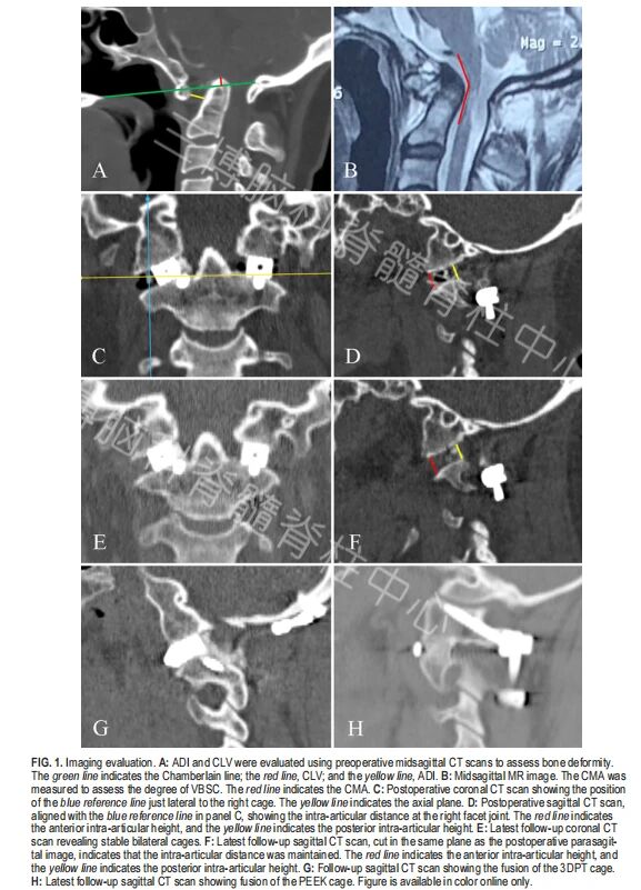 【手术技术分析】3D打印融合器和PEEK融合器用于颅颈交界区畸形关节间手术的效果比较(图2)