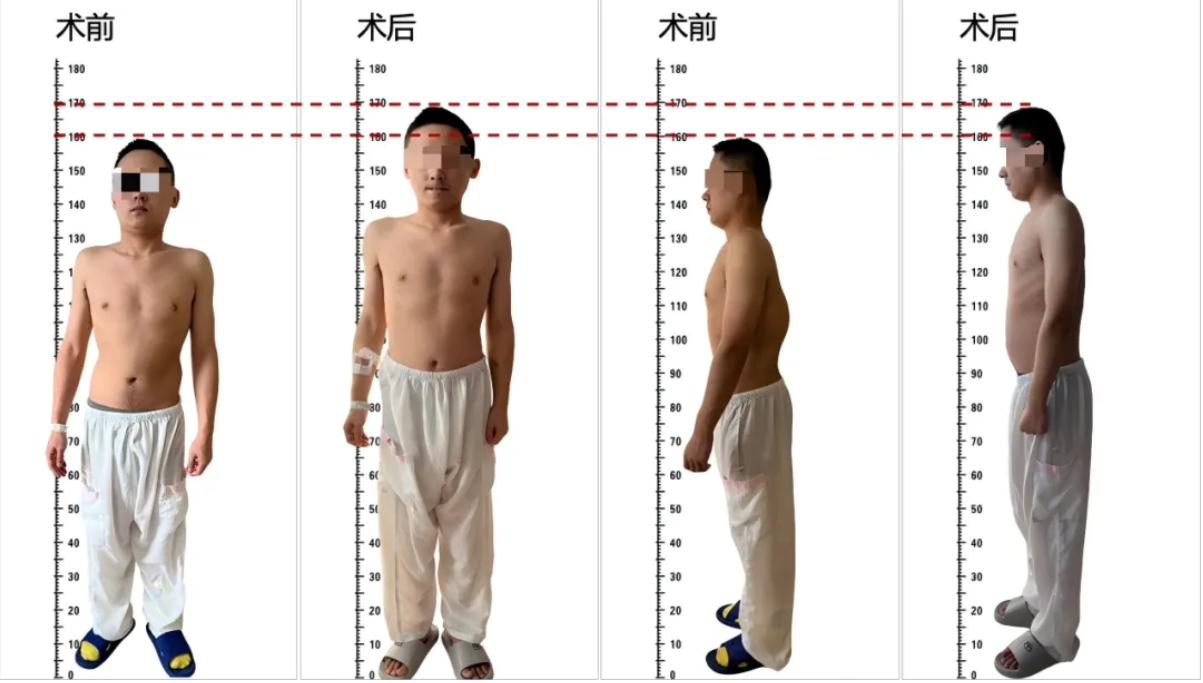 Kaiyun：吉大二院：“AI+3D打印”让“剃刀背”小伙儿站直了长高了(图2)