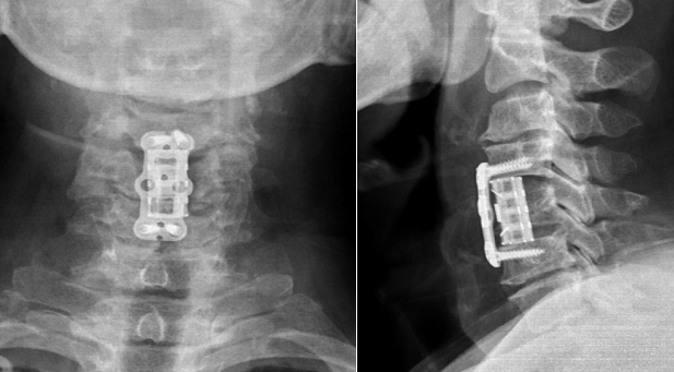 绵阳市骨科医院成功开展3D打印仿生颈椎人工椎体植入术